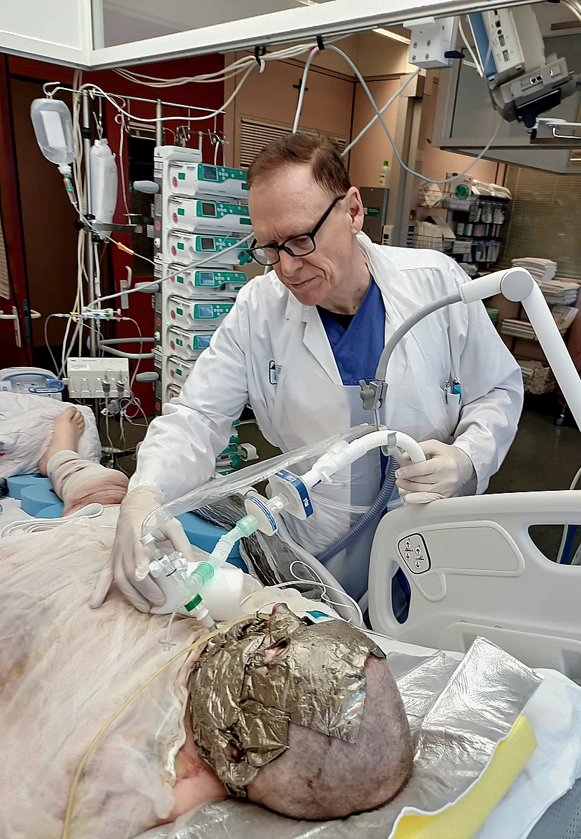 Prof. Ihra managing airway during burn patient care